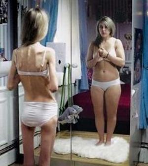 anorexia y bulimia en la adolescencia